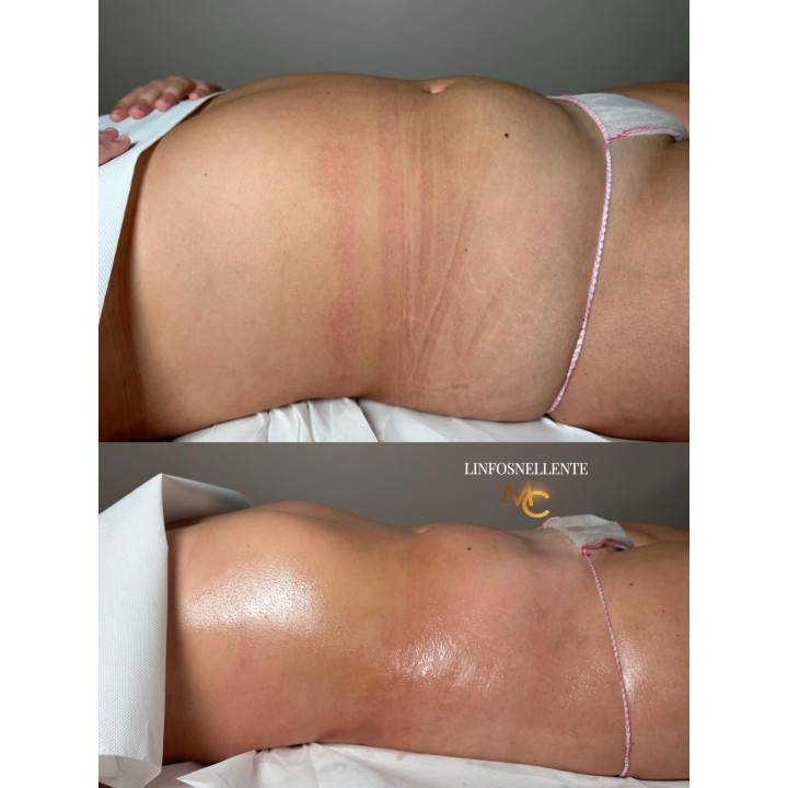 Una seduta di  Linfodrenaggio MC 💎