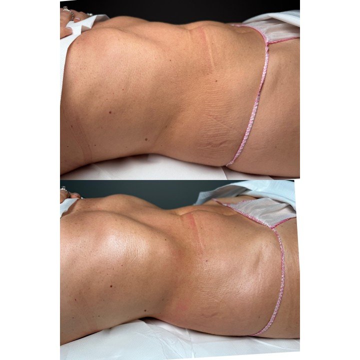 Una seduta di  Linfodrenaggio MC 💎