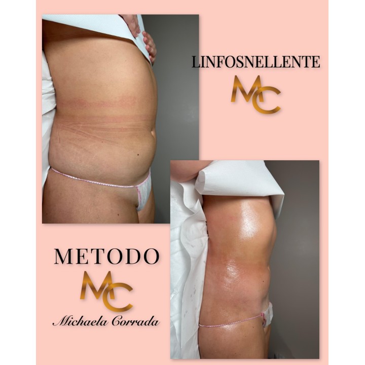 Una seduta di  Linfodrenaggio MC 💎